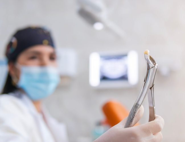 Tooth Extraction in Dearborn